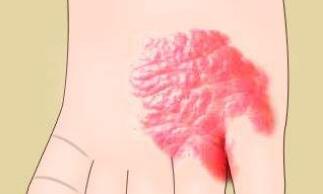 杭州線雕提升魚(yú)尾紋報(bào)價(jià)治療費(fèi)用多少(2023杭州線雕提升魚(yú)尾紋參考價(jià)為：6216元)