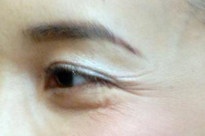 河南手術(shù)祛除動(dòng)態(tài)細(xì)紋的費(fèi)用大概要多少錢一次(2023河南手術(shù)祛除動(dòng)態(tài)細(xì)紋參考價(jià)為：6140元)