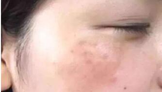 浙江點陣激光除皺的報價全新公開(2023浙江點陣激光除皺參考價為：6522元)