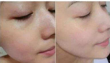 四川皮秒激光去除色素手術(shù)費(fèi)查詢(2023四川皮秒激光去除色素參考價(jià)為：6905元)