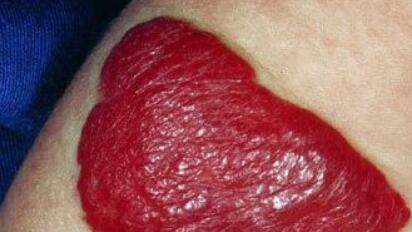 寧波祛眼周紋打針價(jià)格