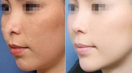 深圳針雕去除口周紋的價錢震撼發(fā)布(2023深圳針雕去除口周紋參考價為：5583元)