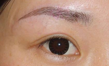 武漢點陣射頻祛眼周細(xì)紋價格消費高嗎(2023武漢點陣射頻祛眼周細(xì)紋參考價為：6394元)