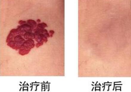 馬鞍山納晶去黑眼圈的手術(shù)費用一般需要多少價格(馬鞍山成美醫(yī)療美容納晶去黑眼圈參考價：3602元)