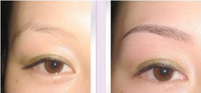 長(zhǎng)沙伊膚泉微針美塑痘坑要多少費(fèi)用(長(zhǎng)沙開(kāi)福美妍醫(yī)療美容門(mén)診部伊膚泉微針美塑痘坑參考價(jià)：4736元)