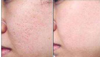 中國電波拉皮去川字紋通常要花費多少錢(中國人民解放軍西藏軍區(qū)總醫(yī)院整形科電波拉皮去川字紋參考價：3033元)