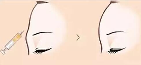 西安胸部玻尿酸填充價目表收費標(biāo)準(zhǔn)公示(西安雁塔女子醫(yī)院胸部玻尿酸填充參考價：5185元)