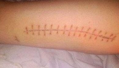 濟(jì)寧嗨體去淚溝/黑眼圈價(jià)格