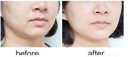 北京聚能環(huán)向分層吸脂手術(shù)價(jià)格搶先看(北京敏護(hù)天秤(美易美時(shí)代)醫(yī)療美容診所聚能環(huán)向分層吸脂參考價(jià)：6253元)