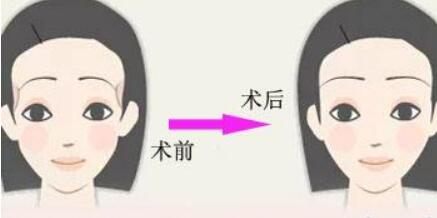 深圳瘦腿抽脂減肥需要手術(shù)價位多少(深圳恒生醫(yī)院瘦腿抽脂減肥參考價：4042元)