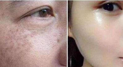 哈爾濱下巴吸脂術(shù)/去雙下巴收費(fèi)價(jià)格圖表一覽(哈爾濱美聯(lián)智美整形美容醫(yī)院下巴吸脂術(shù)/去雙下巴參考價(jià)：6833元)