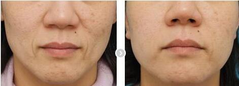 蘇州激光祛疤痕手術(shù)價目表收費標(biāo)準(zhǔn)公示(蘇州常青藤醫(yī)療美容激光祛疤痕手術(shù)參考價：6782元)