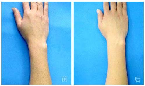 海南黃金微針去頸部皺紋的價格需要多少錢啊(海南和一美整形黃金微針去頸部皺紋參考價：4832元)