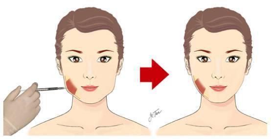 十堰玻尿酸填充法令紋價(jià)格表明細(xì)流出(十堰淑梅婭韓整形美容診所玻尿酸填充法令紋參考價(jià)：4091元)