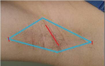 濮陽微創(chuàng)手術(shù)除皺手術(shù)價格表明細(xì)(濮陽博美醫(yī)療整形門診部微創(chuàng)手術(shù)除皺手術(shù)參考價：6693元)