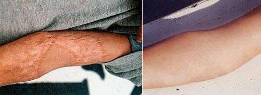 杭州拉皮去除動(dòng)態(tài)細(xì)紋治療價(jià)目表2023收費(fèi)明細(xì)公開(kāi)(永和智發(fā)全國(guó)連鎖杭州分公司拉皮去除動(dòng)態(tài)細(xì)紋參考價(jià)：5225元)