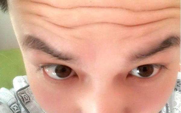 湖州玻尿酸眉間紋填充整形價格表【明細】來襲(湖州曙光威茲曼醫(yī)療美容門診玻尿酸眉間紋填充參考價：5419元)