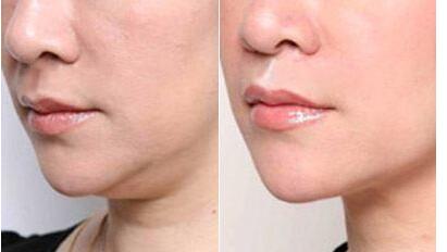 鄭州自體填充去除口周紋治療費用(鄭州星姿醫(yī)療美容醫(yī)院自體填充去除口周紋參考價：6410元)