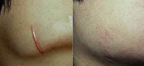 朝陽激光去太田痣手術(shù)價格參考標準(北京朝陽醫(yī)院皮膚性病科激光去太田痣手術(shù)參考價：3862元)