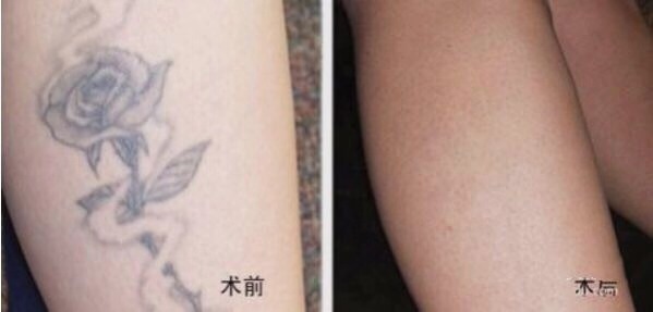 杭州外眼角上提整形費(fèi)用清單預(yù)覽(杭州艾菲醫(yī)療美容門(mén)診部外眼角上提參考價(jià)：6051元)