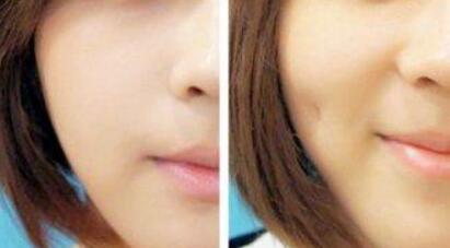 海口人工骨下巴填充一般需要手術(shù)價(jià)格多少(海南?？谑锕鈮?mèng)妮幻醫(yī)療美容人工骨下巴填充參考價(jià)：4755元)