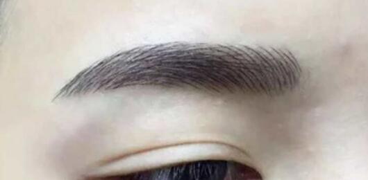 寧波靜態(tài)紋手術祛除價格