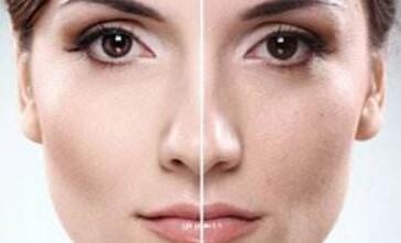 重慶射頻微針祛動態(tài)細(xì)紋價格貴么(重慶怡脂醫(yī)療美容門診部射頻微針祛動態(tài)細(xì)紋參考價：3735元)