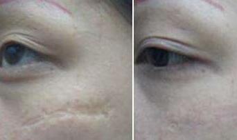 杭州乳房下垂失敗修復(fù)治療價(jià)格表上線查看(杭州健麗醫(yī)療美容診所乳房下垂失敗修復(fù)參考價(jià)：4005元)