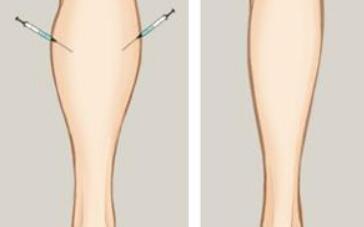 成都大腿做吸脂減肥價格2023明細(xì)查詢(四川成都華西醫(yī)院整形美容科大腿做吸脂減肥參考價：5498元)