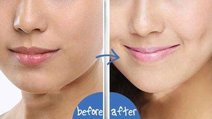 廈門注氧豐胸整形費用清單剖析(廈門蓓蕾斯特醫(yī)療美容門診部注氧豐胸參考價：4387元)