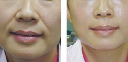 杭州針雕去妊娠紋大概需要手術(shù)價(jià)錢(qián)多少(杭州卓?jī)C整形醫(yī)療美容醫(yī)院針雕去妊娠紋參考價(jià)：5791元)