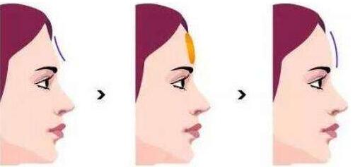 蕪湖注射肉毒素去狐臭2023費(fèi)用全新上線(安徽蕪湖瑞麗整形美容醫(yī)院注射肉毒素去狐臭參考價(jià)：3965元)