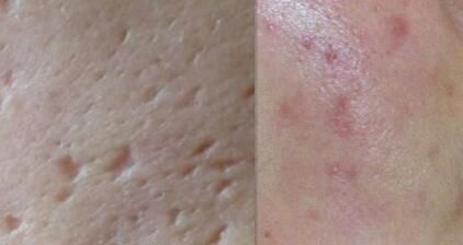 北京臉部吸脂手術(shù)費(fèi)用貴嗎(北京印正山醫(yī)療美容診所臉部吸脂手術(shù)參考價(jià)：5733元)