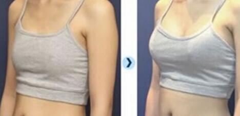 株洲熱拉提祛法令紋治療價(jià)格表展示(株洲華美醫(yī)療美容熱拉提祛法令紋參考價(jià)：3516元)