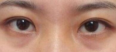 重慶微創(chuàng)面部提升除皺需要花費(fèi)多少費(fèi)用(重慶亞太整形外科診所微創(chuàng)面部提升除皺參考價(jià)：6018元)