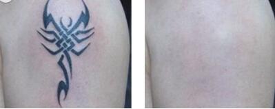 寧波下巴打溶脂針費(fèi)用圖表查詢(武警寧波113醫(yī)院整形美容醫(yī)院下巴打溶脂針參考價(jià)：6541元)