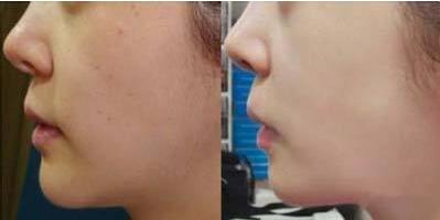 寧波飛秒激光去黑痣的費用大概要多少錢一次(寧波江北韓美醫(yī)療美容門診部飛秒激光去黑痣?yún)⒖純r：5537元)