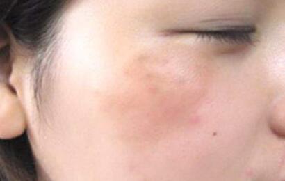 寧德肩部溶脂注射費用明細參考(寧德閩東醫(yī)院醫(yī)學美容科肩部溶脂注射參考價：6647元)