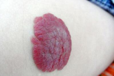 南昌注射瘦小腿報價大致費用是多少(南昌妍澤醫(yī)療美容醫(yī)院注射瘦小腿參考價：4956元)