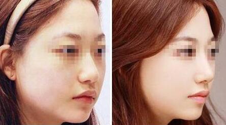 無錫隆胸修復手術價錢一覽表預覽(無錫三院燒傷整形科隆胸修復參考價：3703元)