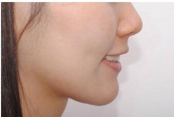 秦皇島淚溝去除手術手術價格全新呈現(xiàn)(秦皇島美姿嬌醫(yī)療美容診所淚溝去除手術參考價：4036元)