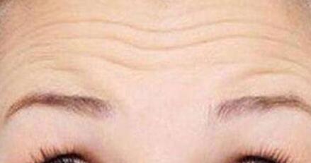 江西玻尿酸注射填充顳部費(fèi)用表上線(江西甄美醫(yī)療美容醫(yī)院玻尿酸注射填充顳部參考價(jià)：5753元)