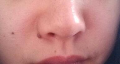 青島強(qiáng)脈沖光祛雀斑整形價(jià)格一覽表明細(xì)(青島金島醫(yī)療整形美容醫(yī)院強(qiáng)脈沖光祛雀斑參考價(jià)：5143元)