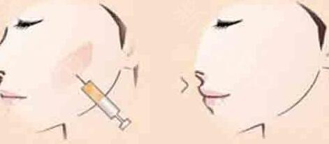 寧波大拉皮去印第安紋收費(fèi)標(biāo)準(zhǔn)趨勢圖一覽(寧波鄞州新顏元辰醫(yī)療美容診所大拉皮去印第安紋參考價：4911元)