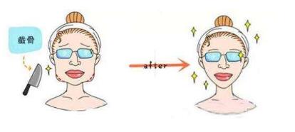 長沙激光眼部除皺法價格