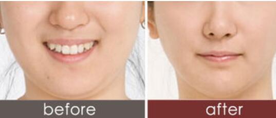 湖南光電去印第安紋大致收費標(biāo)準(zhǔn)是多少錢(湖南長沙第整形美容醫(yī)院光電去印第安紋參考價：3215元)