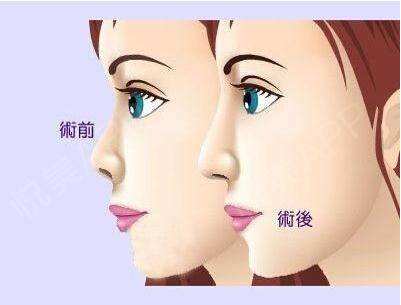 大理隆胸修復(fù)手術(shù)手術(shù)多少錢(大理星辰悅美醫(yī)療美容門診部隆胸修復(fù)手術(shù)參考價(jià)：4161元)