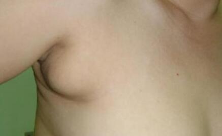 貴陽胸部修復術價目表全新公布(貴陽應超小李飛刀醫(yī)療美容整形醫(yī)院胸部修復術參考價：3730元)