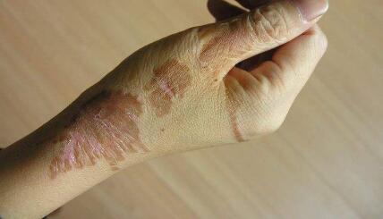 武漢木偶紋激光去除價(jià)目表全新一覽(武漢中愛(ài)整形醫(yī)院木偶紋激光去除參考價(jià)：6360元)