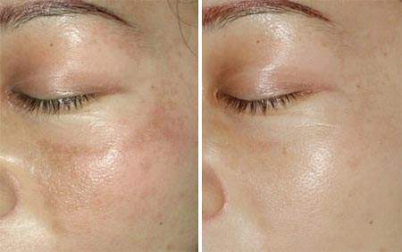 西安熊貓針去眼睛細(xì)紋價(jià)格